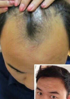 头发种植 头发种植